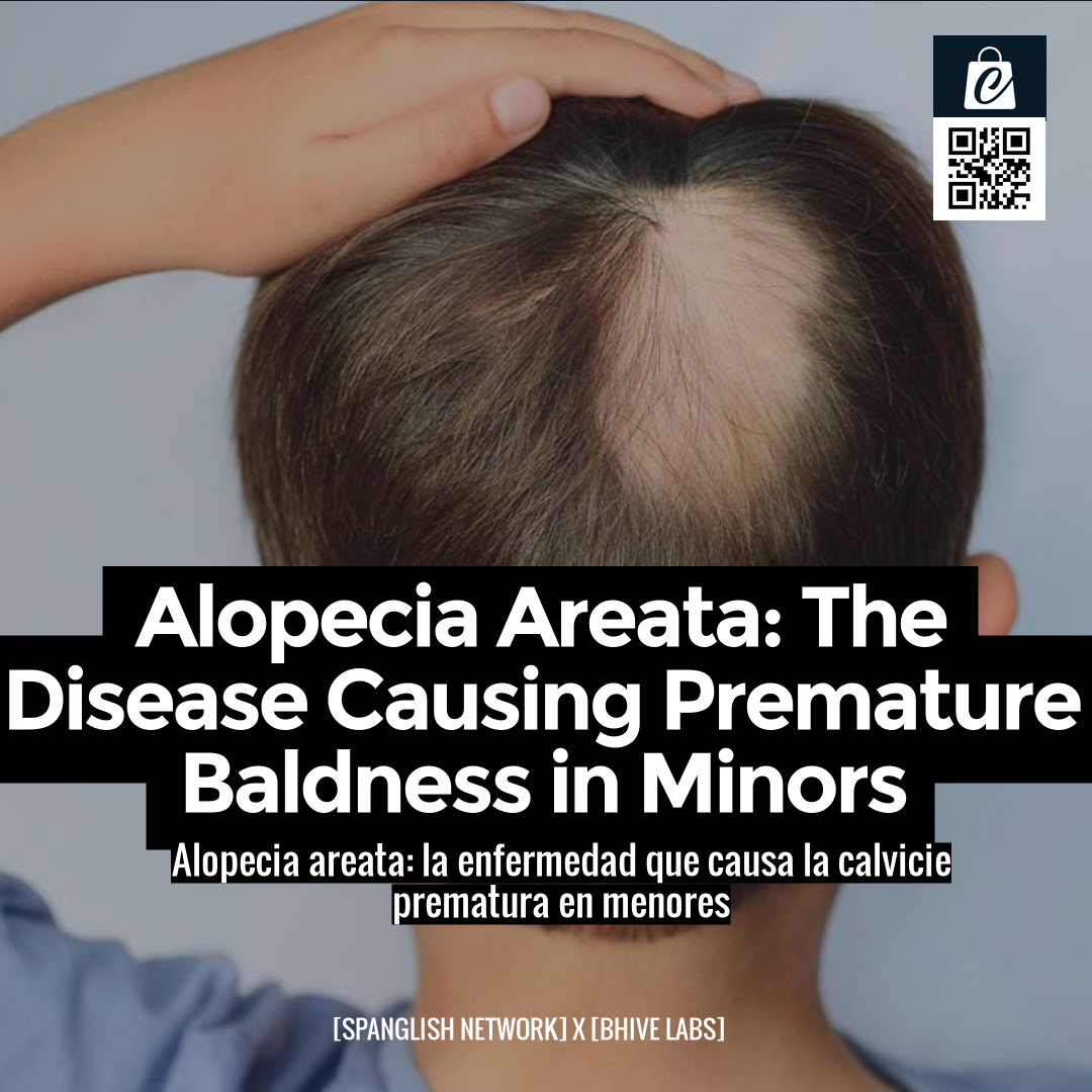 Alopecia Areata: The Disease Causing Premature Baldness in Minors